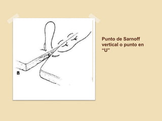 Punto de Sarnoff
vertical o punto en
“U”
 