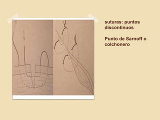 suturas: puntos
discontinuos
Punto de Sarnoff o
colchonero
 