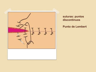 suturas: puntos
discontinuos
Punto de Lembert
 