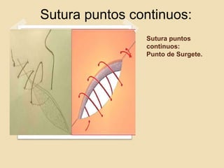 Sutura puntos
continuos:
Punto de Surgete.
Sutura puntos continuos:
 