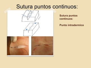 Sutura puntos
continuos:
Punto intradermico
Sutura puntos continuos:
 