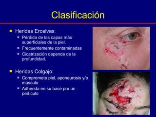  Heridas Erosivas:
 Pérdida de las capas más
superficiales de la piel.
 Frecuentemente contaminadas
 Cicatrización depende de la
profundidad.
 Heridas Colgajo:
 Compromete piel, aponeurosis y/o
músculo
 Adherida en su base por un
pedículo
Clasificación
 