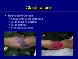  Traumatismo Cerrado:
 No hay pérdida de la continuidad.
 Lesión de piel no evidente.
 Lesión profunda.
 Evolucionan a escaras
Clasificación
 