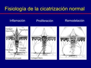 Inflamación Proliferación Remodelación
Fisiología de la cicatrización normal
 