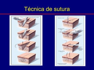 Técnica de sutura
 