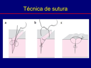 Técnica de sutura
 