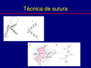 Técnica de sutura
 