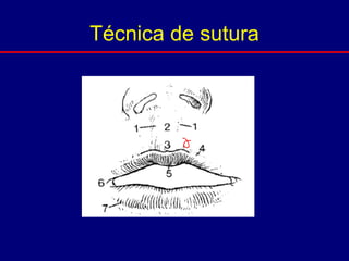 Técnica de sutura
 