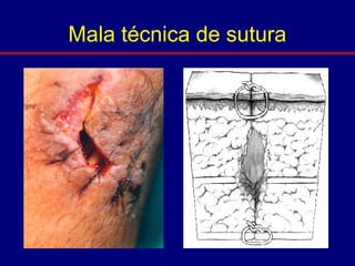Mala técnica de sutura
 