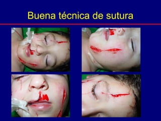 Buena técnica de sutura
 