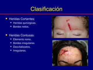  Heridas Cortantes:
 Heridas quirúrgicas.
 Bordes netos.
 Heridas Contusas:
 Elemento romo.
 Bordes irregulares.
 Desvitalizados.
 Irregulares.
Clasificación
 
