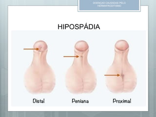 DOENÇAS CAUSADAS PELO
HERMAFRODITISMO
HIPOSPÁDIA
 