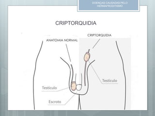 CRIPTORQUIDIA
DOENÇAS CAUSADAS PELO
HERMAFRODITISMO
 