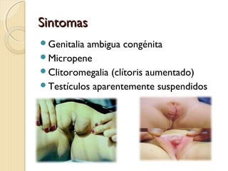 SintomasSintomas
Genitalia ambigua congénita
Micropene
Clitoromegalia (clítoris aumentado)
Testículos aparentemente suspendidos
 