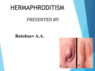HERMAPHRODITISM
PRESENTED BY:
Botobaev A.A.
1
 