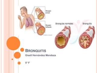 BRONQUITIS
Gisell Hernández Mendoza
5° F
 