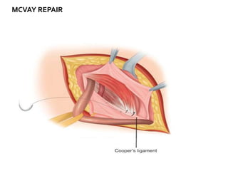 Mcvay Incision Hernia | PPTX