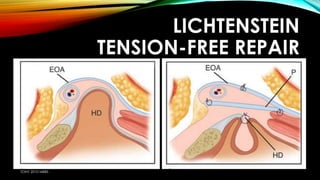 LICHTENSTEIN 
TENSION-FREE REPAIR 
TONY 2010 MBBS 
 