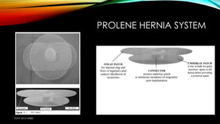 PROLENE HERNIA SYSTEM 
TONY 2010 MBBS 
 