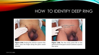 HOW TO IDENTIFY DEEP RING 
TONY 2010 MBBS 
 