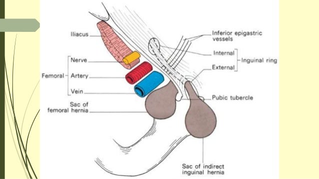 Superficial Inguinal Ring Vs Deep Inguinal Ring Superficial Inguinal Ring Vs Deep Inguinal Ring