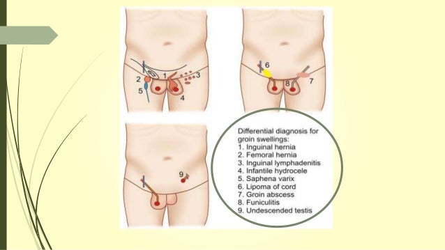 D R A G O S Hernia From The Sages Video Library