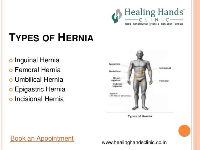 Hernia Symptoms Types and Treatment