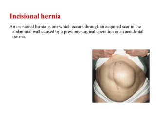 Incisional hernia
An incisional hernia is one which occurs through an acquired scar in the
abdominal wall caused by a previous surgical operation or an accidental
trauma.
 