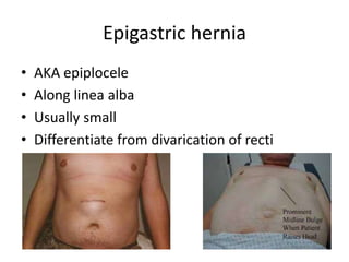 Epigastric hernia
• AKA epiplocele
• Along linea alba
• Usually small
• Differentiate from divarication of recti
 