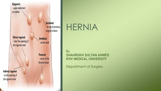 HERNIA
By
SHAHRUKH SULTAN AHMED
KYIV MEDICAL UNIVERSITY
Department of Surgery
 