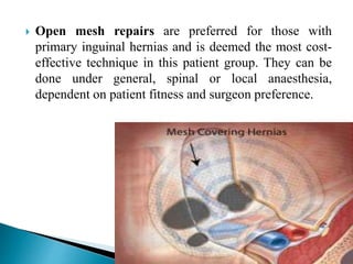  Open mesh repairs are preferred for those with
primary inguinal hernias and is deemed the most cost-
effective technique in this patient group. They can be
done under general, spinal or local anaesthesia,
dependent on patient fitness and surgeon preference.
 