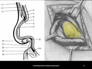 Herniation Rosh Hernia - Physiotherapy - Dr Rohit Bhaskar | PDF