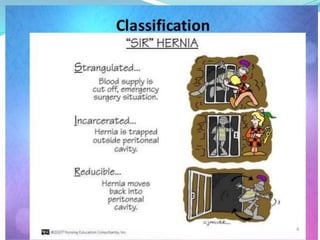 Hernia | PPTX