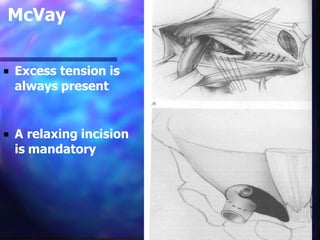 Mcvay Incision Hernia | PDF