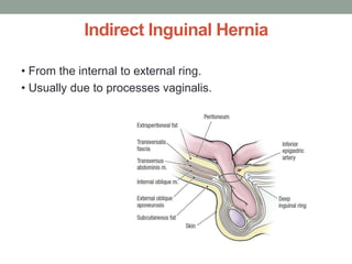 Indirect Inguinal Hernia
• From the internal to external ring.
• Usually due to processes vaginalis.
 