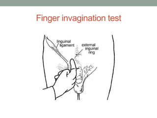 Finger invagination test
 