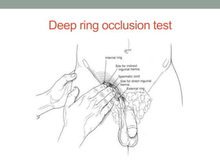 Deep ring occlusion test
 