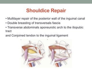 Shouldice Repair
• Multilayer repair of the posterior wall of the inguinal canal
• Double breasting of transversals fascia
• Transverse abdominals aponeurotic arch to the iliopubic
tract
and Conjoined tendon to the inguinal ligament
 