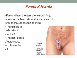 Femoral Hernia
• Femoral hernia enters the femoral ring,
traverses the femoral canal and comes out
through the saphenous opening.
• The female to
male ratio is
about 2:1.
• The right side is
affected twice
as often as the
left.
 