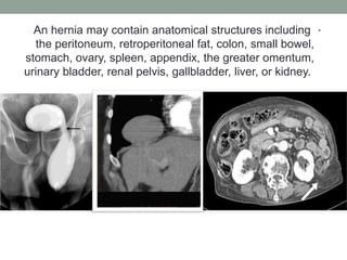 •
An hernia may contain anatomical structures including
the peritoneum, retroperitoneal fat, colon, small bowel,
stomach, ovary, spleen, appendix, the greater omentum,
urinary bladder, renal pelvis, gallbladder, liver, or kidney.
 