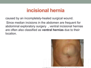 incisional hernia
caused by an incompletely-healed surgical wound.
Since median incisions in the abdomen are frequent for
abdominal exploratory surgery , ventral incisional hernias
are often also classified as ventral hernias due to their
location.
 
