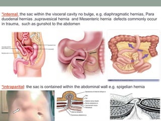 *internal :the sac within the visceral cavity no bulge, e.g. diaphragmatic hernias, Para
duodenal hernias ,supravesical hernia and Mesenteric hernia defects commonly occur
in trauma, such as gunshot to the abdomen
the sac is contained within the abdominal wall e.g. spigelian hernia
:
*intraparital
 
