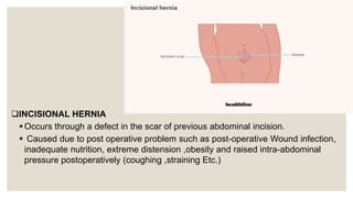 INCISIONAL HERNIA
Occurs through a defect in the scar of previous abdominal incision.
 Caused due to post operative problem such as post-operative Wound infection,
inadequate nutrition, extreme distension ,obesity and raised intra-abdominal
pressure postoperatively (coughing ,straining Etc.)
 