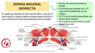 Es aquella que atraviesa el anillo inguinal interno y baja por el
canal inguinal; en algunos casos se extiende hasta el escroto, lo
que se conoce como hernia inguinoescrotal o hernia completa.
 Son las más comunes de todas las
hernias.
 Los hombres las presentan de 5 a 10
veces más frecuentemente que las
mujeres.
 5 al 7% de los hombres desarrollaran una
hernia inguinal indirecta.
 Por lo general ocurren durante la quinta
década de su vida.
 
