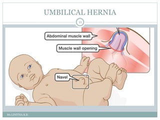 UMBILICAL HERNIA
Ms.LINITHA.K.B.
11
 