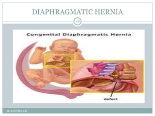 DIAPHRAGMATIC HERNIA
Ms.LINITHA.K.B.
18
 