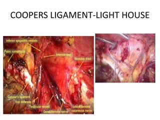 COOPERS LIGAMENT-LIGHT HOUSE
 