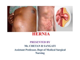 PRESENTED BY
Mr. CHETAN R SANGATI
Assistant Professor, Dept of Medical Surgical
Nursing
HERNIA
 