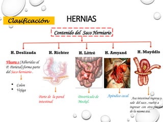 HERNIAS
Clasificación
Contenido del Saco Herniario
H. Deslizada
Víscera s (Adheridas al
P. Parietal) forma parte
del Saco herniario .
H. Richter H. Amyand
H. Littré
 Colon
 Vejiga
Parte de la pared
intestinal
Divertículo de
Meckel.
Apéndice cecal
H. Mayddls
Asa intestinal ingresa y
sale del saco , vuelve a
ingresar con otra porción
de la misma asa.
 