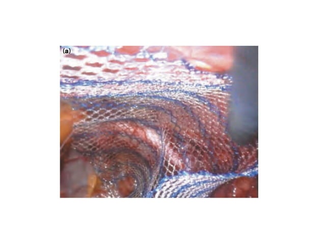 Hernia inguinal femoral ventral.pptx.pdf